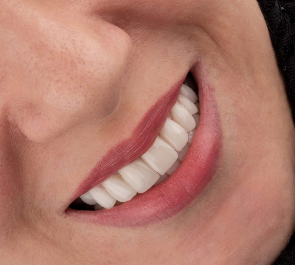 نمونه کار لمینت در مشهد و ونیر کامپوزیت دکتر رضایی