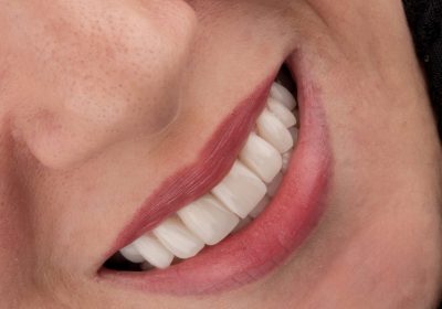 نمونه کار لمینت در مشهد و ونیر کامپوزیت دکتر رضایی