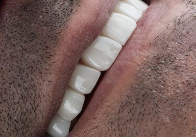 ایمپلنت و ونیرکامپوزیت دندان در مشهد دکتر ضابر پوریبا رضائی