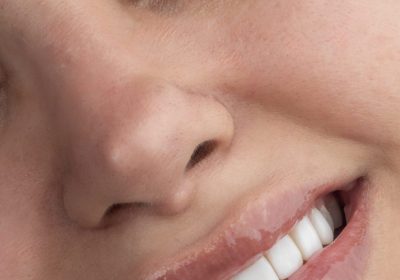 نمونه کار ونیر کامپوزیت مشهد دکتر رضایی