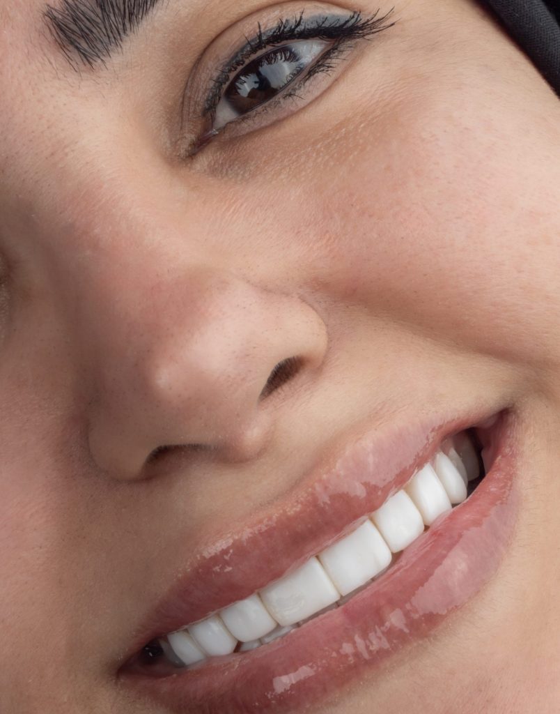 نمونه کار ونیر کامپوزیت مشهد دکتر رضایی