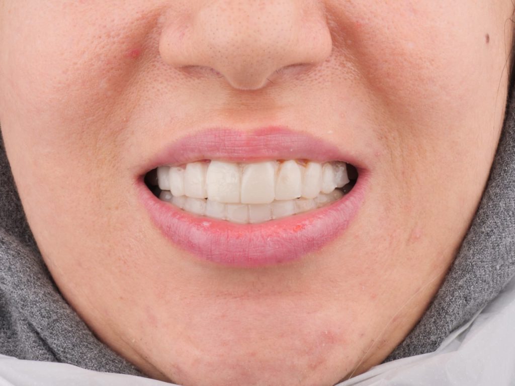 نمونه کار بعدر ایمپلنت در مشهد