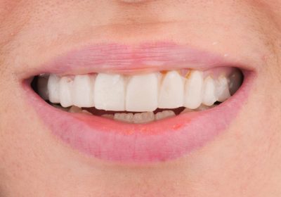 دکتر صابر پوریا رضایی متخصص ایمپلنت در مشهد نمونه کار یک