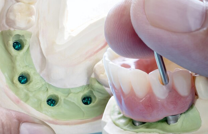 دندان مصنوعی، بهترین نوع دندان مصنوعی، دندان مصنوعی ثابت، دندان مصنوعی متحرک، دندان مصنوعی تکی