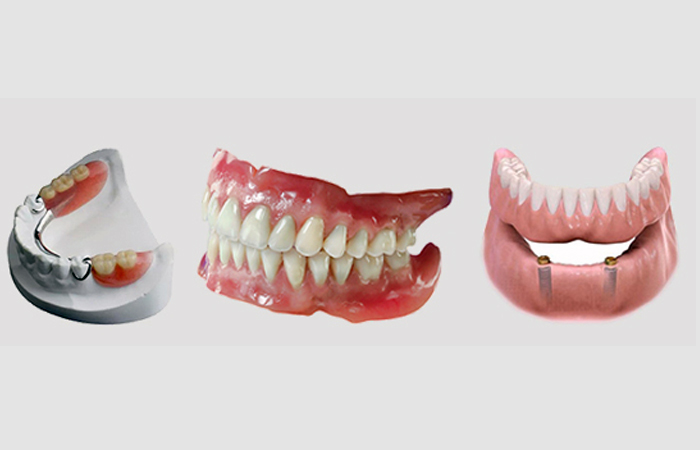 فول دنچر یا دست دندان کامل ، قیمت دنچر دندان ، اورنچر دندان چیست ، دنچر چیست ، اورنچر چیست