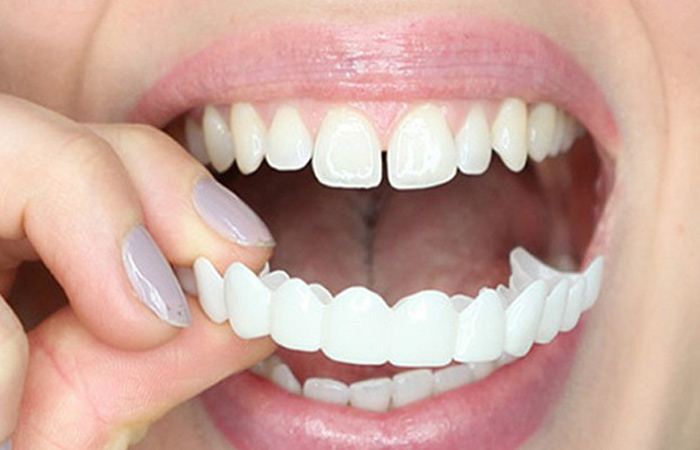 لمینت متحرک دندان