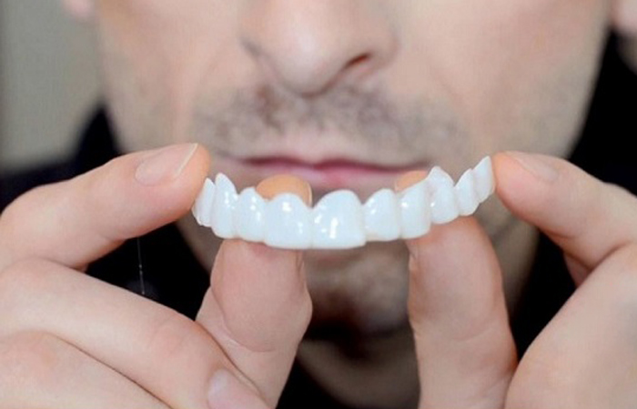 لمینت متحرک دندان