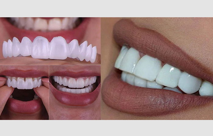 لمینت متحرک دندان ، قیمت لمینت متحرک دندان ، روکش موقت دندان در داروخانه ، طرز استفاده از لمینت متحرک دندان ، اسنپ آن اسمایل