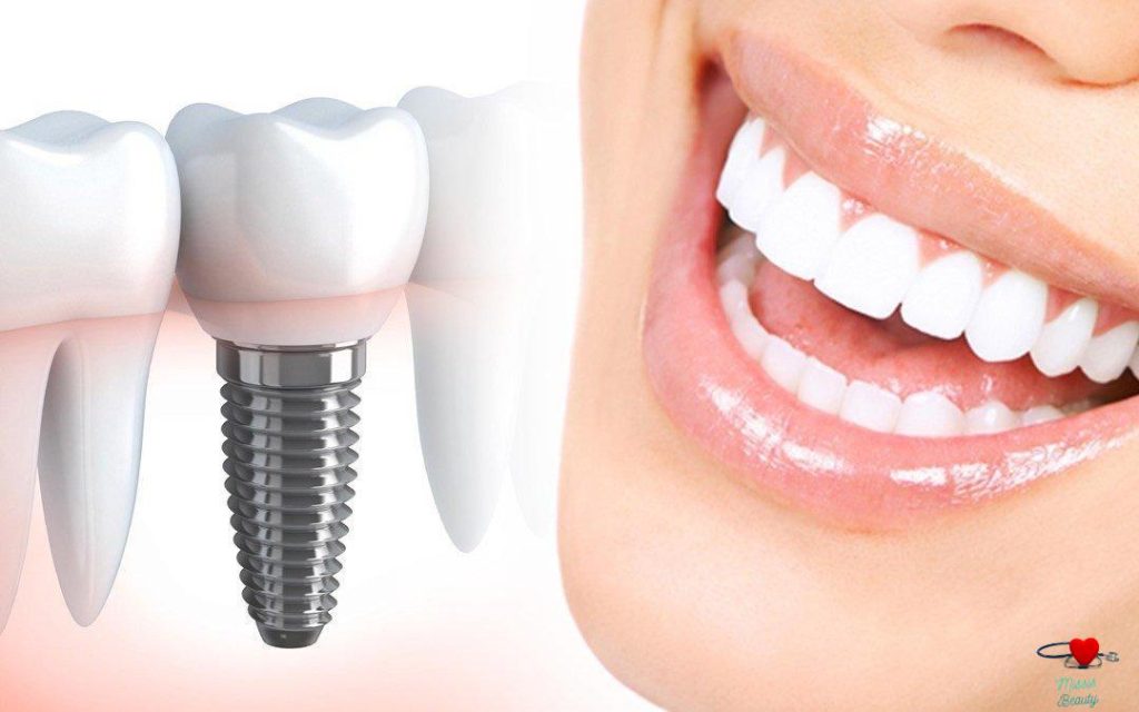 ایمپلنت دندان در مشهد