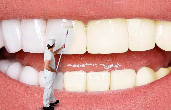 بلیچینگ دندان