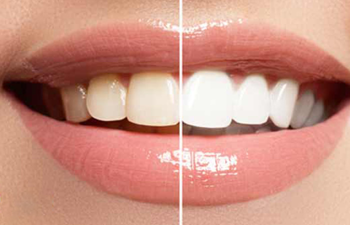 ونیر کامپوزیت در مشهد 