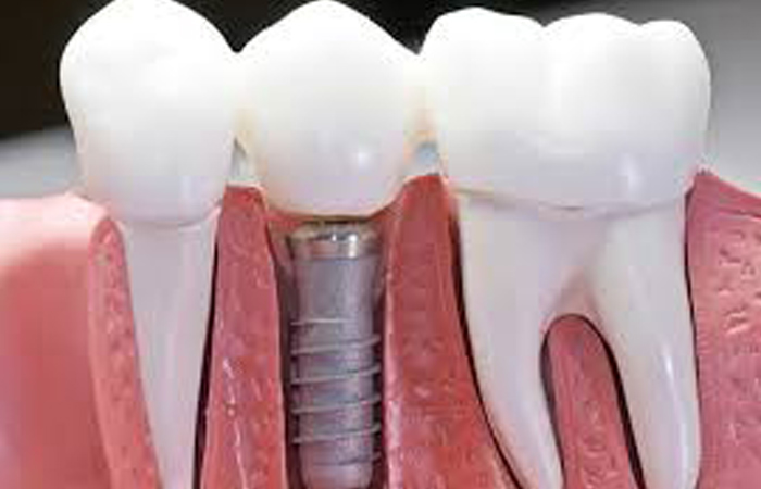 ایمپلنت دندان در مشهد ، ایمپلنت مشهد ، بهترین دکتر ایمپلنت در مشهد ، هزینه ایمپلنت دندان در مشهد ، بهترین دندانپزشک مشهد