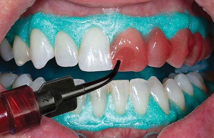 بلیچینگ دندان ، هزینه بلیچینپ دندان ، عوارض بلیچینگ دندان ، مراحل بلیچینگ دندان ، ماندگاری بلیچینگ دندان