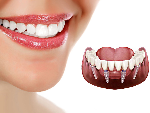 مراحل ایمپلنت دندان