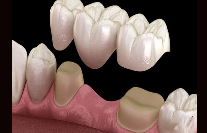 بریج دندان ، بریج دندان چیست ، معایب بریج دندان چیست ، آیا بریج دندان خوب است ، طول عمر بریج دندان ، عکس بریج دندان جلو