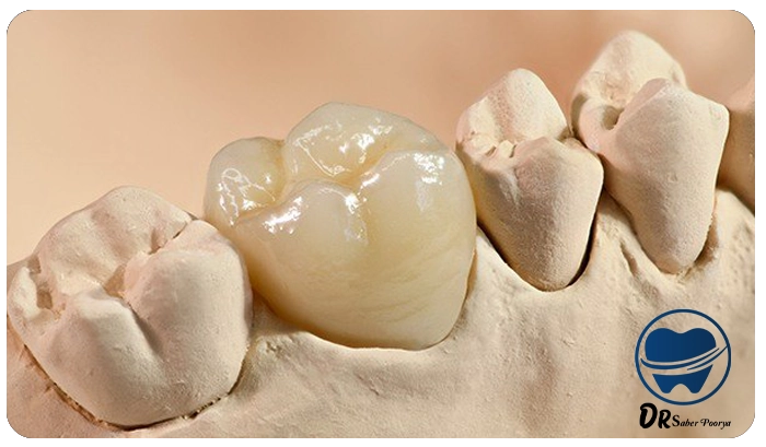 روکش دندان در مشهد