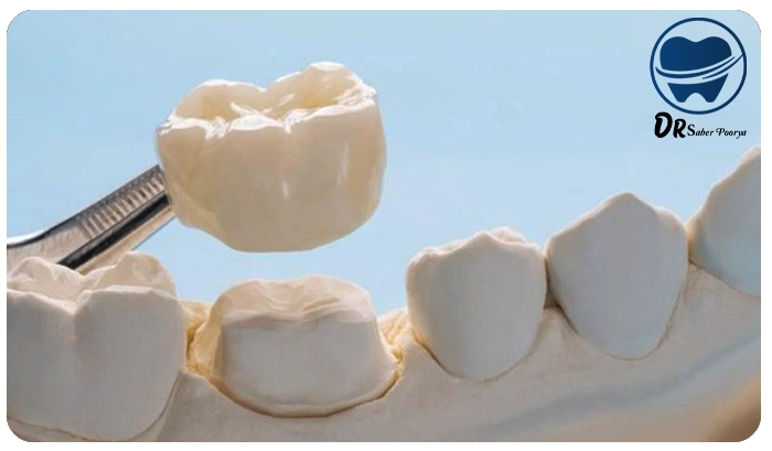 روکش دندان در مشهد، هزینه روکش دندان در مشهد، بهترین دندانپزشک روکش مشهد، کلینیک دندانپزشکی مشهد، تفاوت روکش PFM و زیرکونیا، ترمیم دندان با روکش، قیمت روکش دندان سرامیکی، مراحل روکش دندان