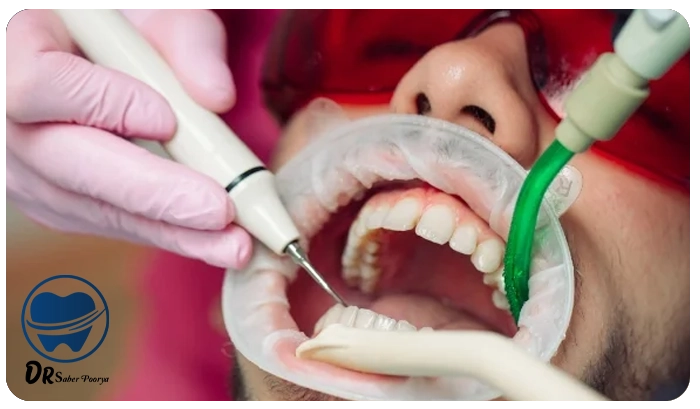 جرم‌گیری دندان در مشهد