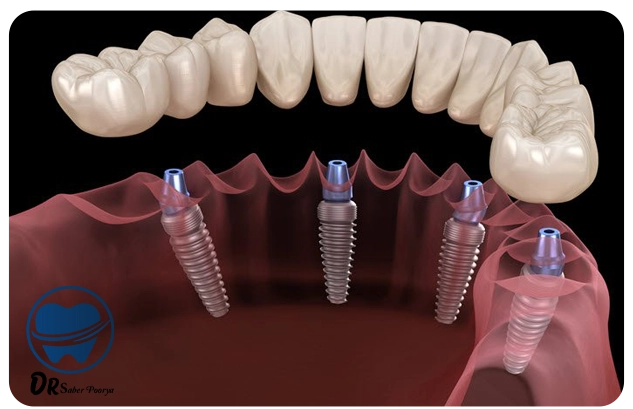 کلینیک ایمپلنت دندان مشهد