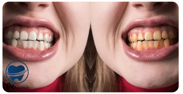 لیچینگ دندان چقدر ماندگاری دارد