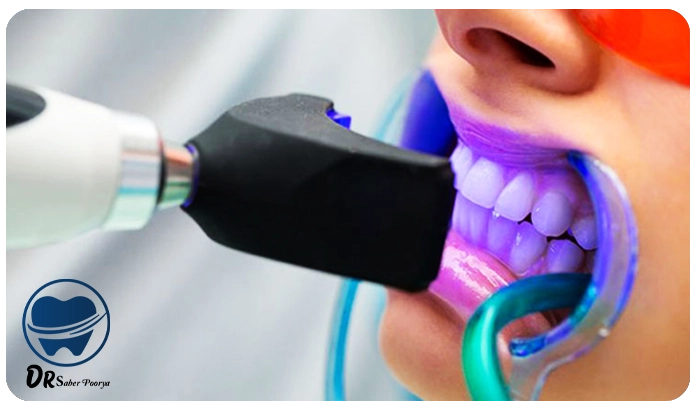 بلیچینگ دندان در مشهد