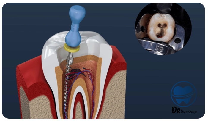 درمان ریشه کودکان