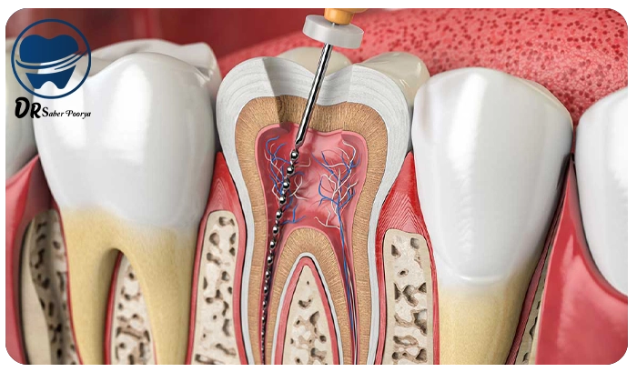 درمان ریشه در مشهد