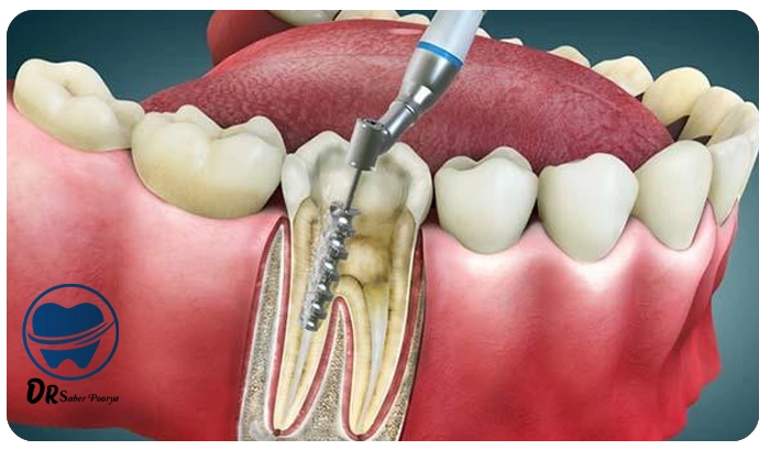 درمان ریشه در مشهد، عصب‌کشی در مشهد، هزینه درمان ریشه، بهترین دندانپزشک عصب‌کشی مشهد، درد دندان و درمان ریشه، درمان ریشه دندان آسیاب، درمان ریشه کودکان، درمان آبسه دندان در مشهد
