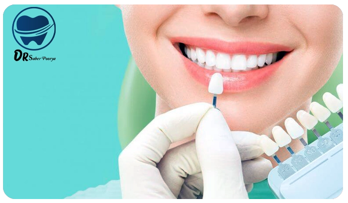 لمینت دندان در مشهد