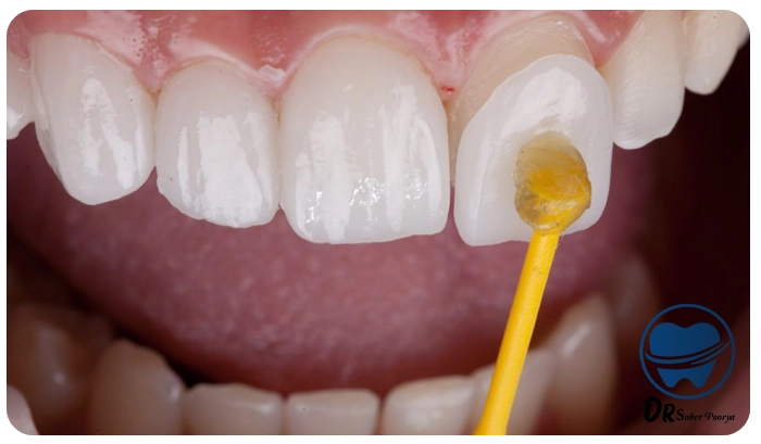 هزینه لمینت دندان 