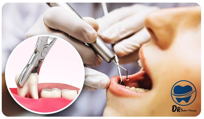 کشیدن دندان عقل در مشهد