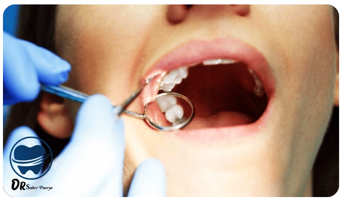 کشیدن دندان عقل در مشهد، هزینه کشیدن دندان عقل، بهترین دندانپزشک برای دندان عقل در مشهد، مراقبت بعد از کشیدن دندان عقل، جراحی دندان عقل نهفته، تورم بعد از کشیدن دندان عقل، کشیدن دندان عقل با بی‌حسی، کلینیک دندانپزشکی مشهد، درد دندان عقل، کشیدن دندان عقل بالا