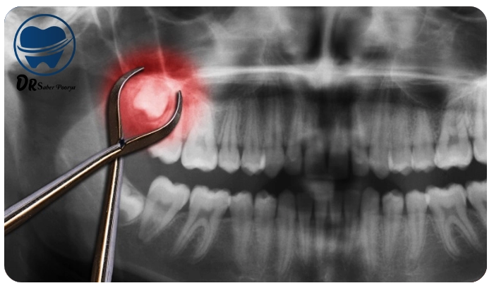 هزینه کشیدن دندان عقل 