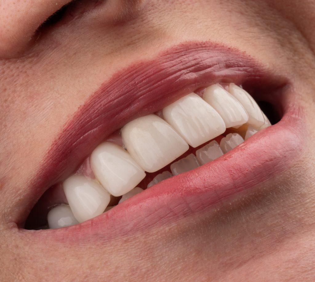 نمونه کار ایمپلنت و لیمنت در مشهد دکتر رضایی