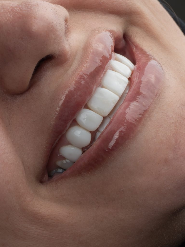 ونیر کامپوزیت مشهد نمونه کار دکتر رضایی سجاد مشهد