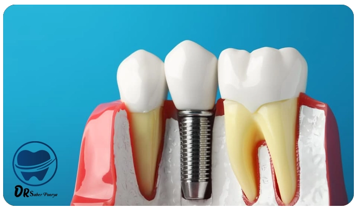مراحل کاشت ایمپلنت دندان از صفر تا صد با عکس