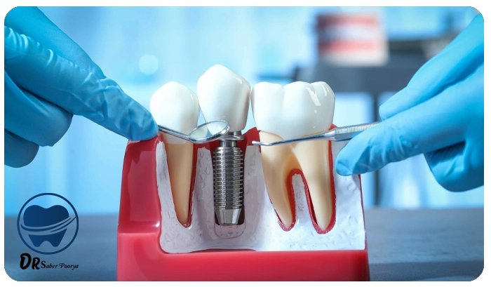 مراحل کاشت ایمپلنت دندان از صفر تا صد با عکس