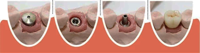 مراحل کاشت ایمپلنت دندان از صفر تا صد با عکس