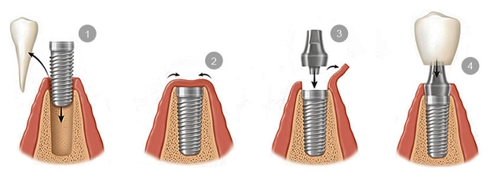 مراحل کاشت ایمپلنت دندان از صفر تا صد با عکس