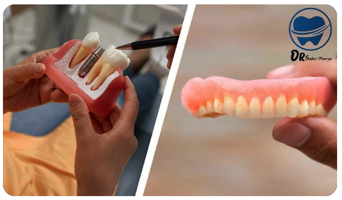 ایمپلنت بهتر است یا دندان مصنوعی