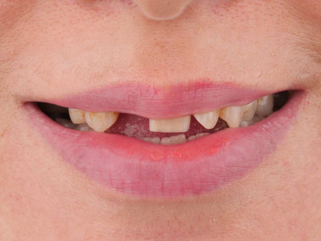 قبل کار نمونه کار ایمپلنت در مشهد دندان های جلو