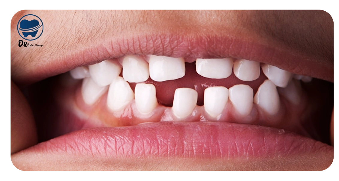 رفع فاصله بین دندانها