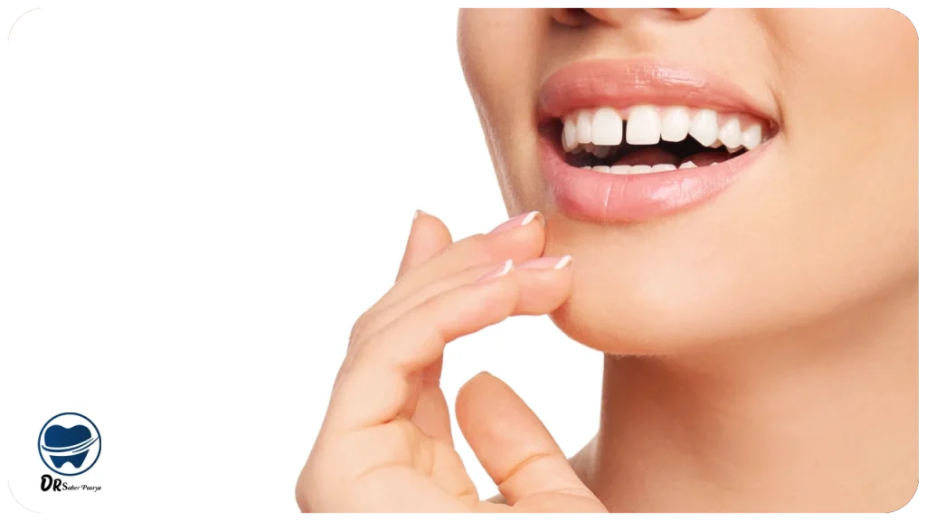 رفع فاصله بین دندان‌ها