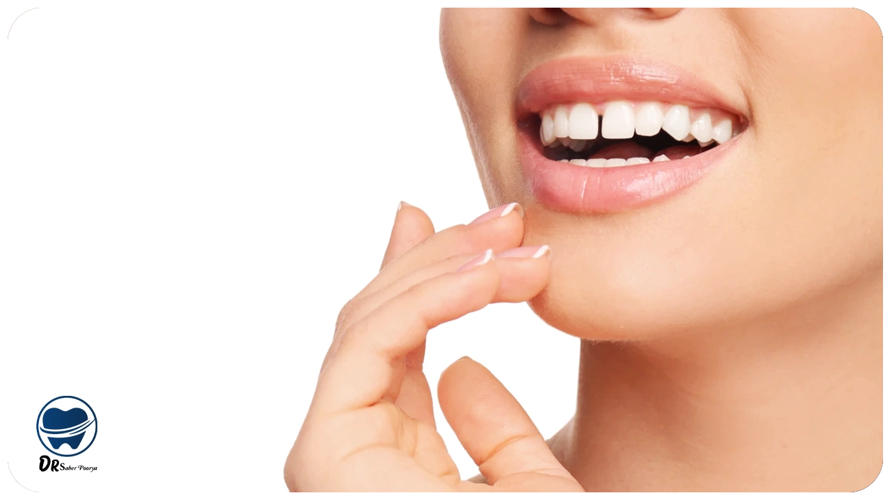 رفع فاصله بین دندان‌ها
