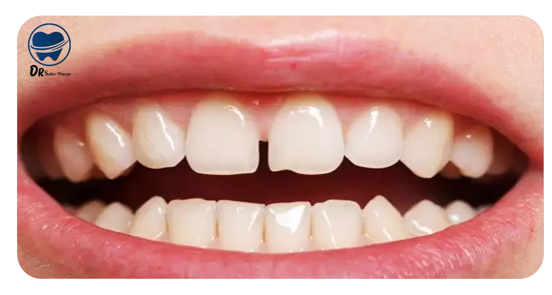 رفع فاصله بین دندانها