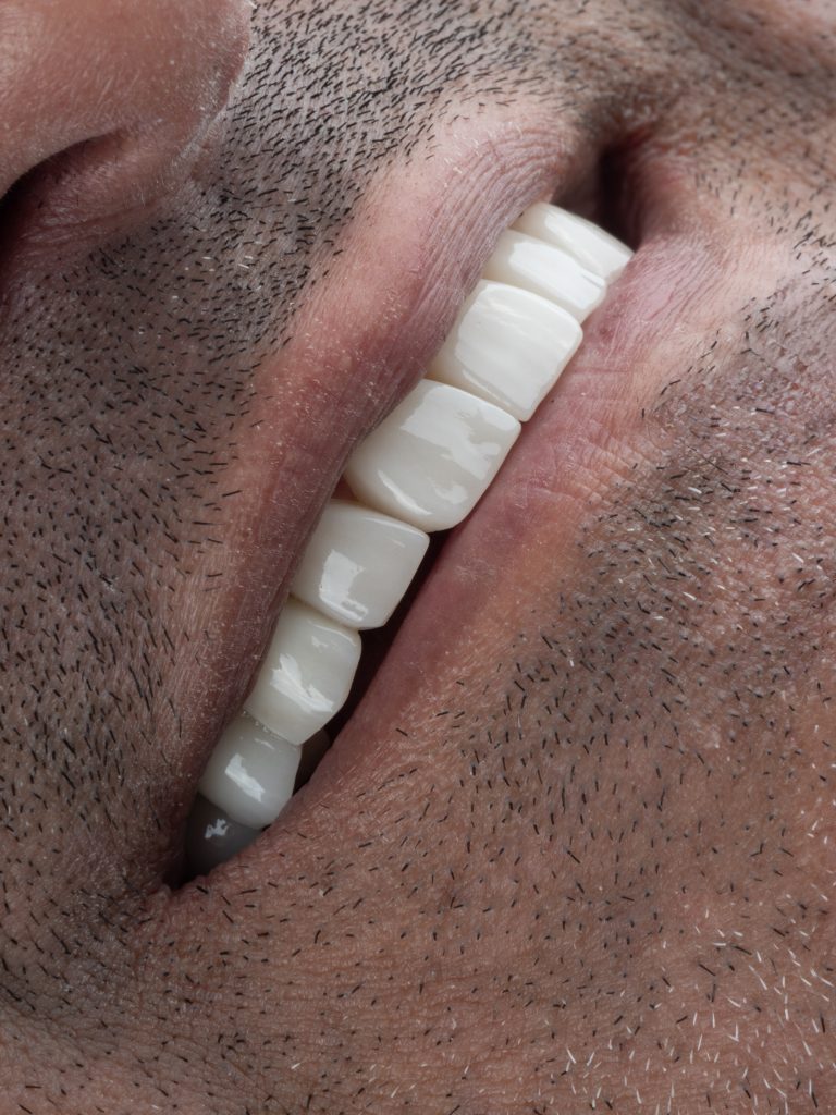 ونیر کامپوزیت مشهد و ایمپلنت دکتر صابر پوریا رضائی