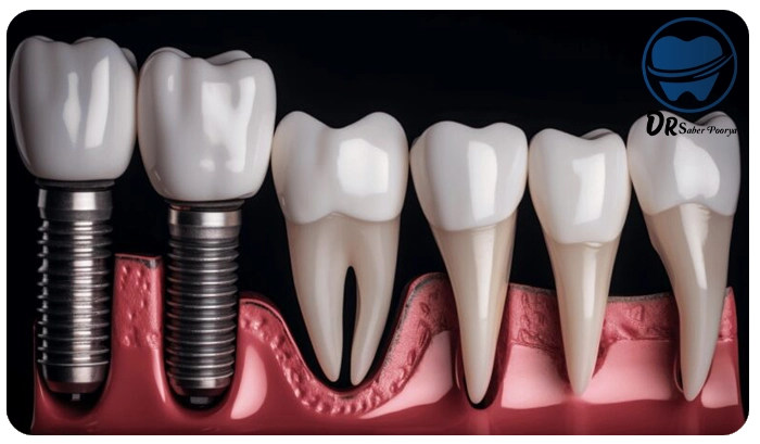 ایمپلنت فوری در مشهد