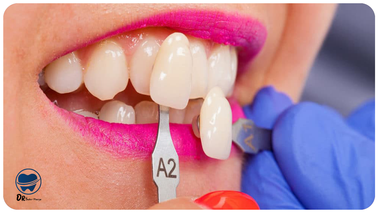 عوارض لمینت دندان؛ واقعیت یا شایعات رایج؟