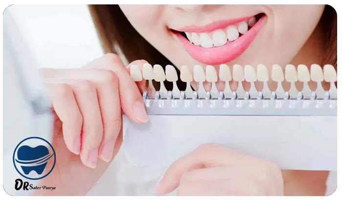 لمینت دندان بهتر است یا کامپوزیت