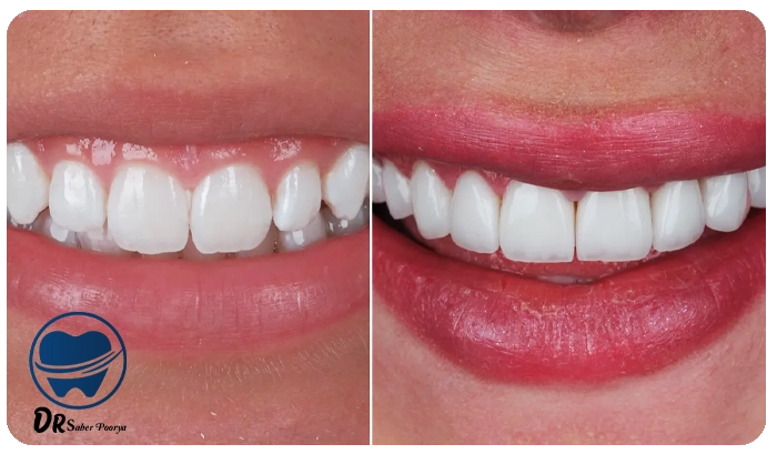 لمینت دندان بهتر است یا کامپوزیت